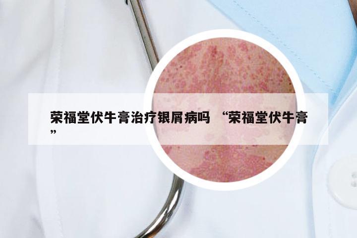 荣福堂伏牛膏治疗银屑病吗 “荣福堂伏牛膏”