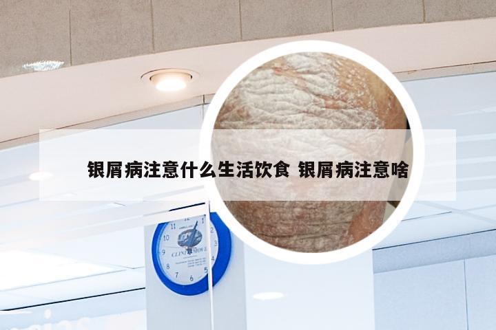 银屑病注意什么生活饮食 银屑病注意啥