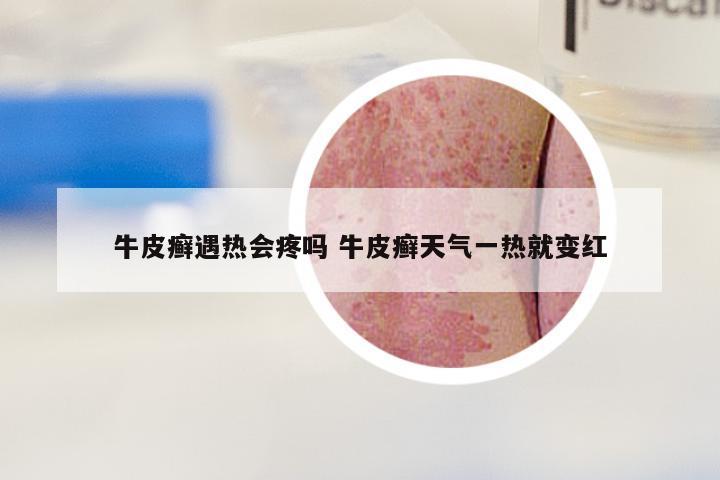 牛皮癣遇热会疼吗 牛皮癣天气一热就变红