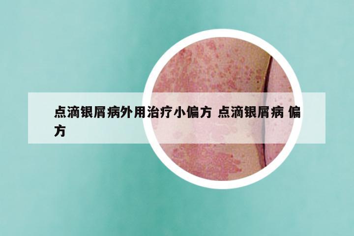 点滴银屑病外用治疗小偏方 点滴银屑病 偏方