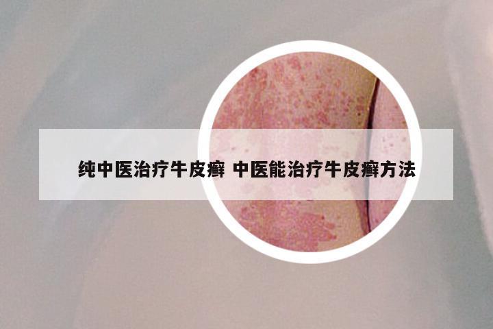 纯中医治疗牛皮癣 中医能治疗牛皮癣方法