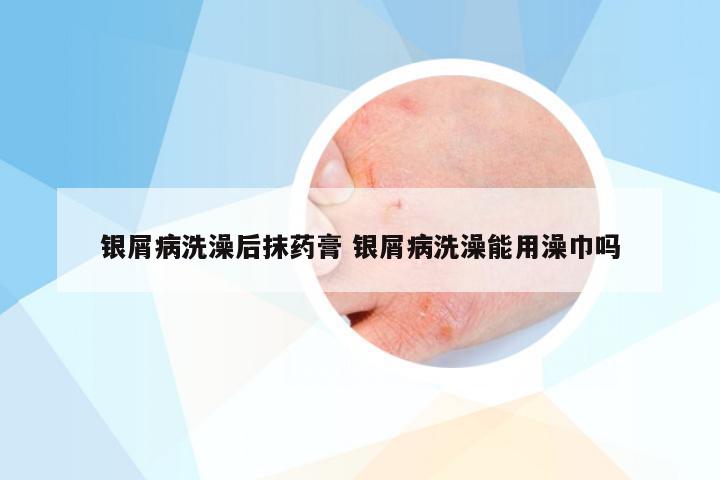 银屑病洗澡后抹药膏 银屑病洗澡能用澡巾吗