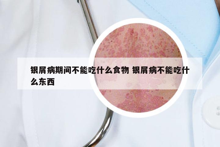 银屑病期间不能吃什么食物 银屑病不能吃什么东西