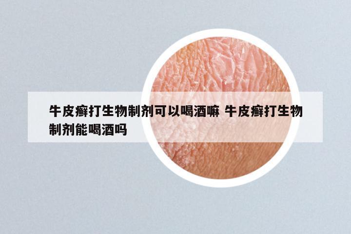 牛皮癣打生物制剂可以喝酒嘛 牛皮癣打生物制剂能喝酒吗