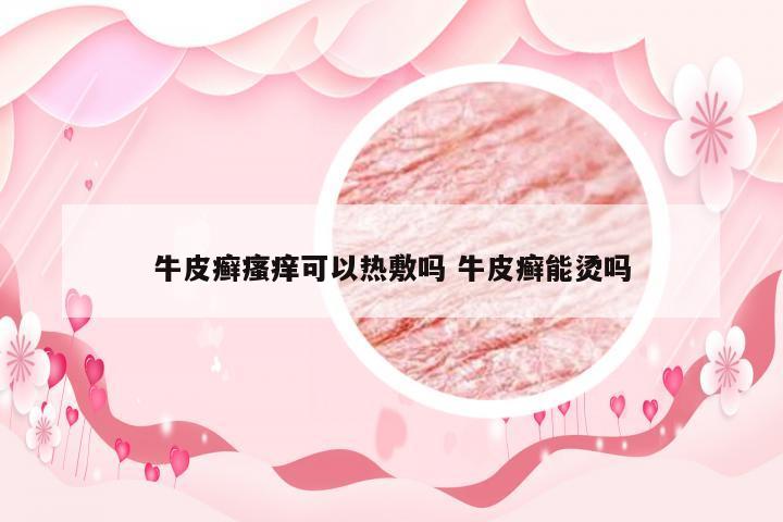 牛皮癣瘙痒可以热敷吗 牛皮癣能烫吗