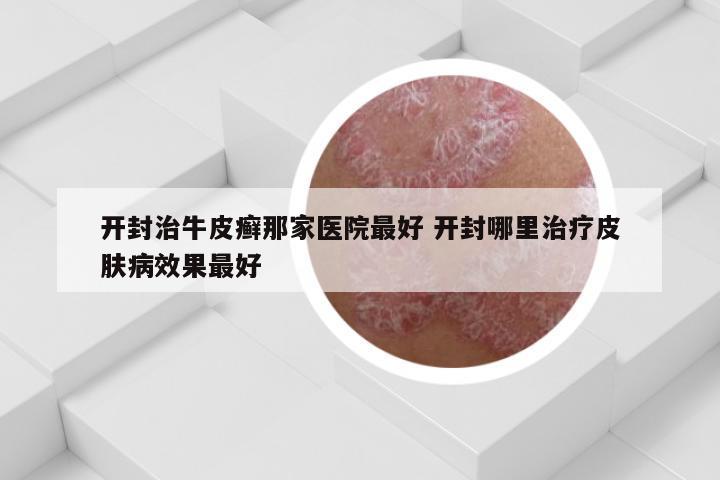开封治牛皮癣那家医院最好 开封哪里治疗皮肤病效果最好