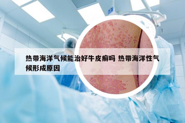 热带海洋气候能治好牛皮癣吗 热带海洋性气候形成原因
