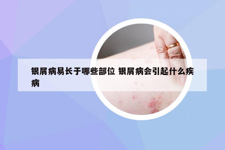 银屑病易长于哪些部位 银屑病会引起什么疾病