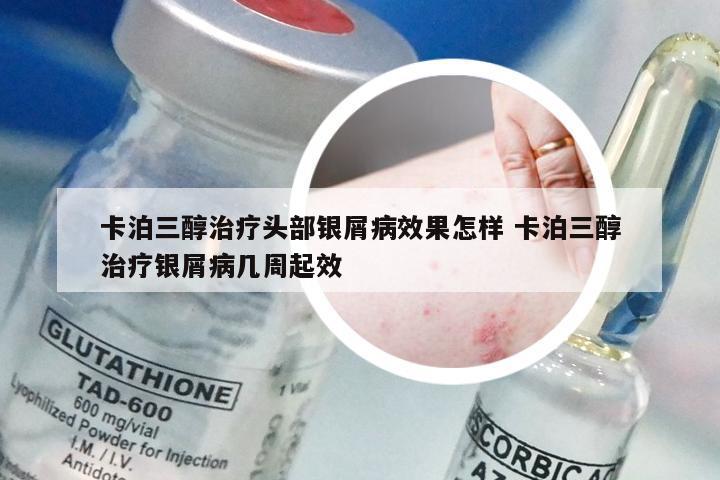 卡泊三醇治疗头部银屑病效果怎样 卡泊三醇治疗银屑病几周起效