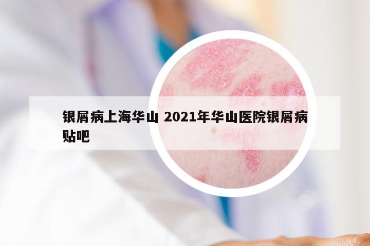 银屑病上海华山 2021年华山医院银屑病贴吧