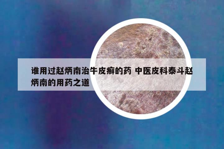谁用过赵炳南治牛皮癣的药 中医皮科泰斗赵炳南的用药之道