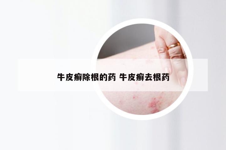 牛皮癣除根的药 牛皮癣去根药