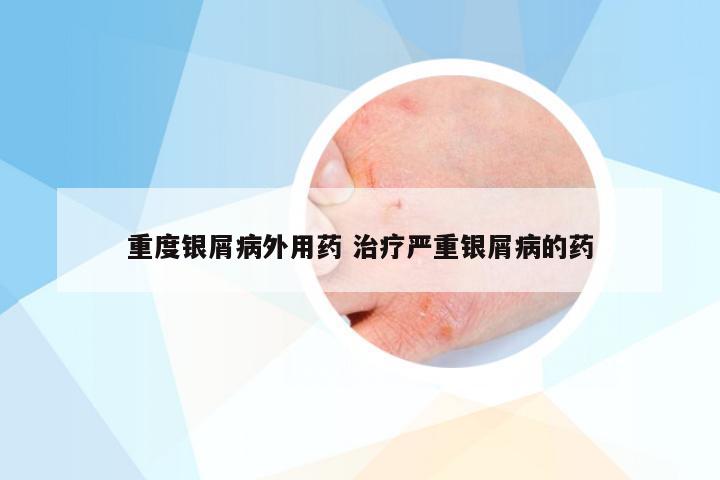 重度银屑病外用药 治疗严重银屑病的药