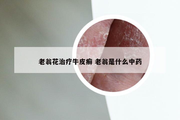 老翁花治疗牛皮癣 老翁是什么中药
