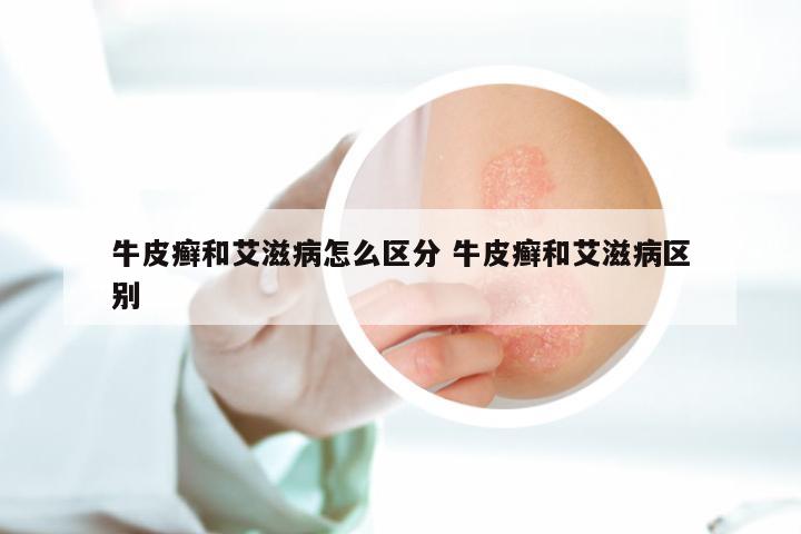 牛皮癣和艾滋病怎么区分 牛皮癣和艾滋病区别
