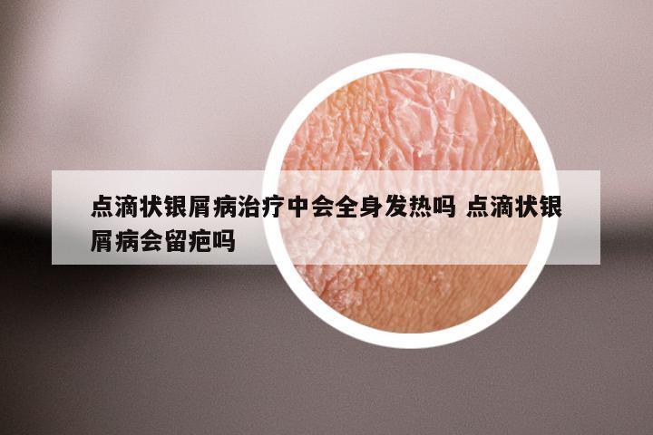 点滴状银屑病治疗中会全身发热吗 点滴状银屑病会留疤吗