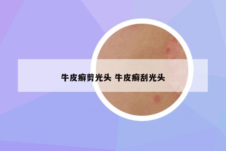 牛皮癣剪光头 牛皮癣刮光头