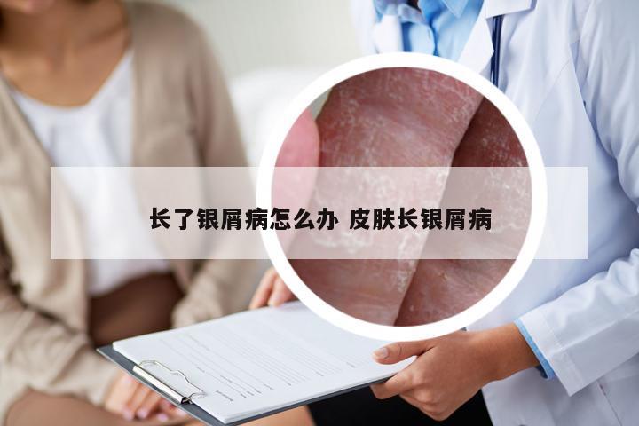 长了银屑病怎么办 皮肤长银屑病