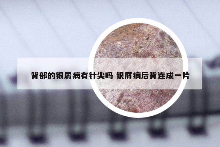 背部的银屑病有针尖吗 银屑病后背连成一片