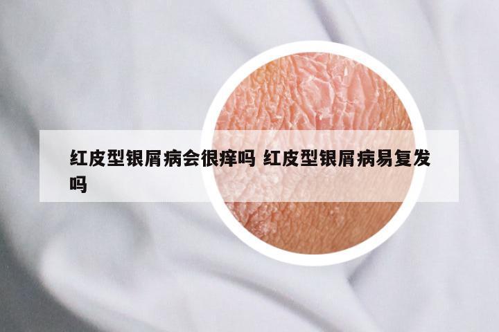 红皮型银屑病会很痒吗 红皮型银屑病易复发吗