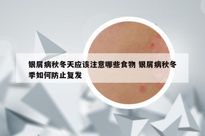 银屑病秋冬天应该注意哪些食物 银屑病秋冬季如何防止复发