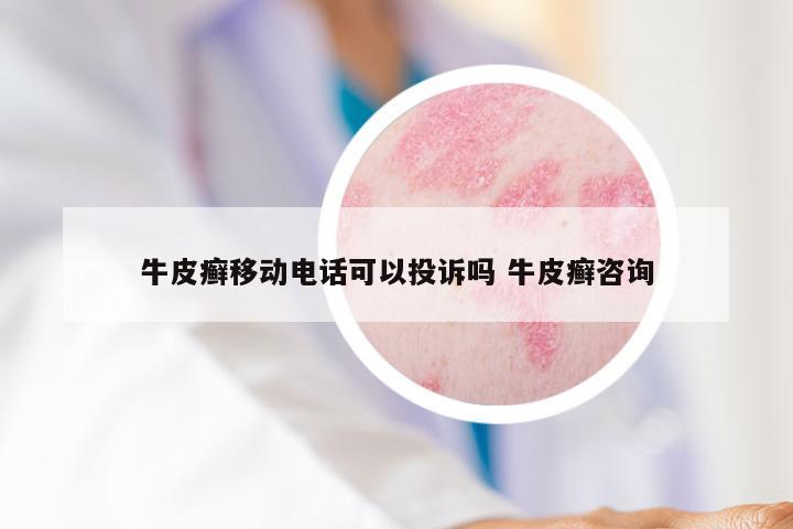 牛皮癣移动电话可以投诉吗 牛皮癣咨询