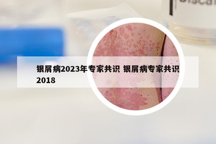 银屑病2023年专家共识 银屑病专家共识2018