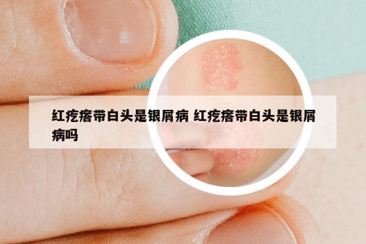 红疙瘩带白头是银屑病 红疙瘩带白头是银屑病吗