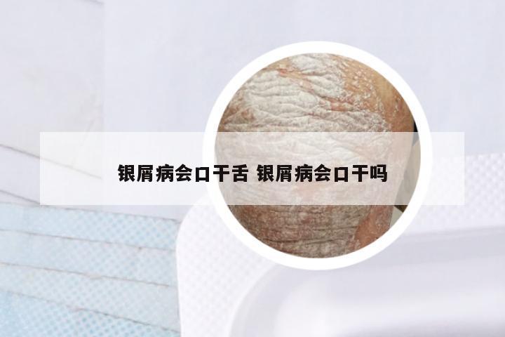 银屑病会口干舌 银屑病会口干吗