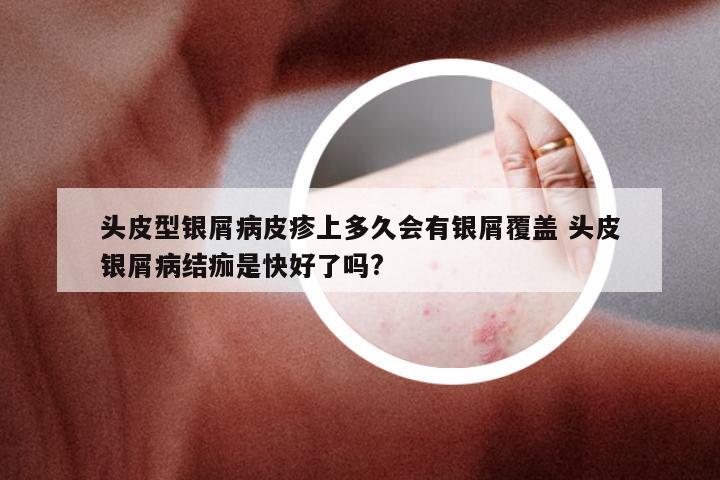 头皮型银屑病皮疹上多久会有银屑覆盖 头皮银屑病结痂是快好了吗?
