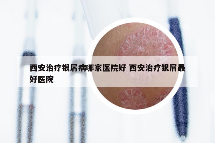 西安治疗银屑病哪家医院好 西安治疗银屑最好医院