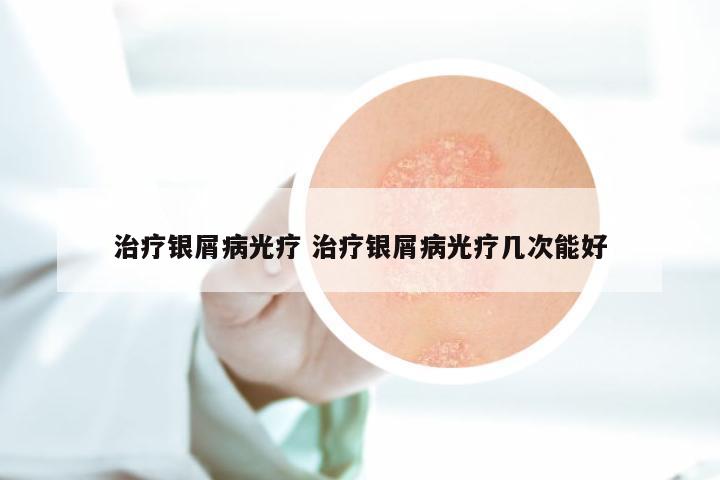 治疗银屑病光疗 治疗银屑病光疗几次能好