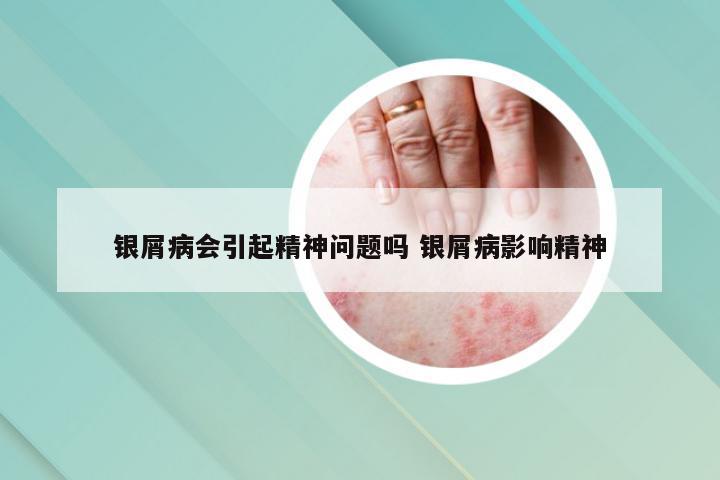 银屑病会引起精神问题吗 银屑病影响精神