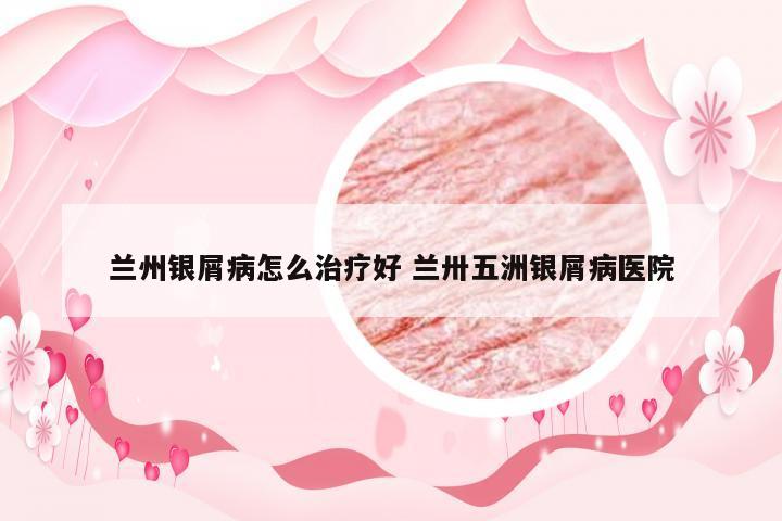 兰州银屑病怎么治疗好 兰卅五洲银屑病医院