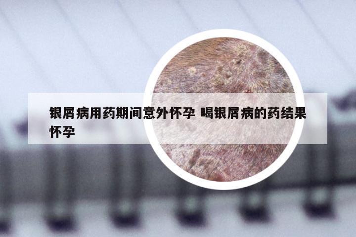 银屑病用药期间意外怀孕 喝银屑病的药结果怀孕