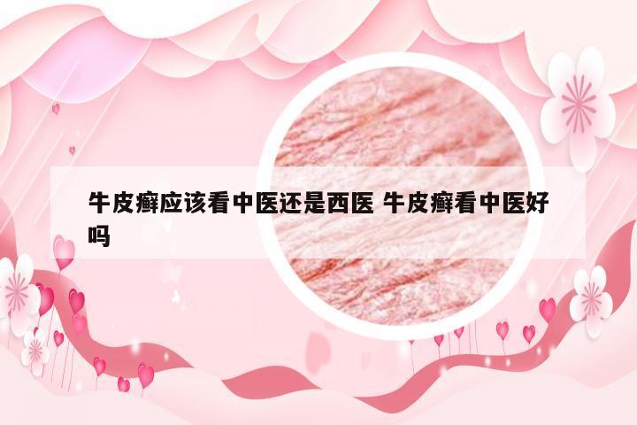 牛皮癣应该看中医还是西医 牛皮癣看中医好吗
