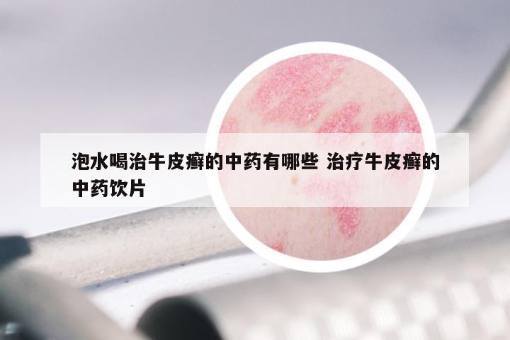 泡水喝治牛皮癣的中药有哪些 治疗牛皮癣的中药饮片