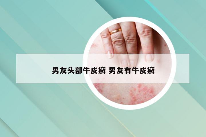 男友头部牛皮癣 男友有牛皮癣