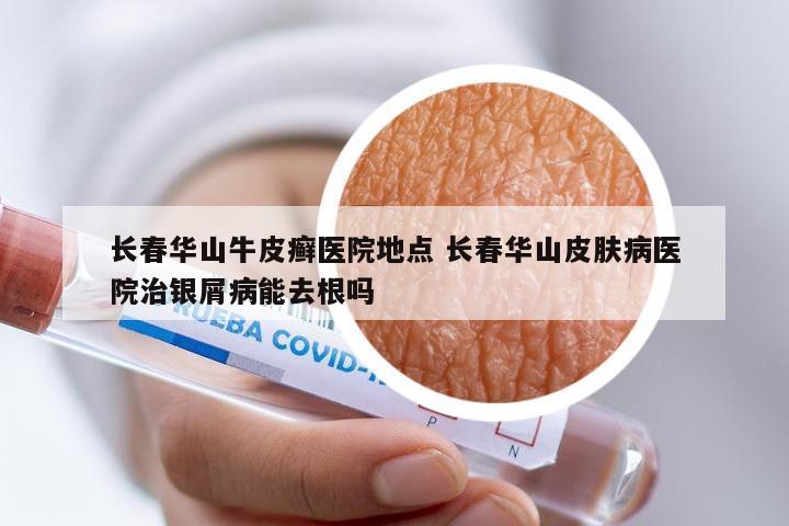 长春华山牛皮癣医院地点 长春华山皮肤病医院治银屑病能去根吗