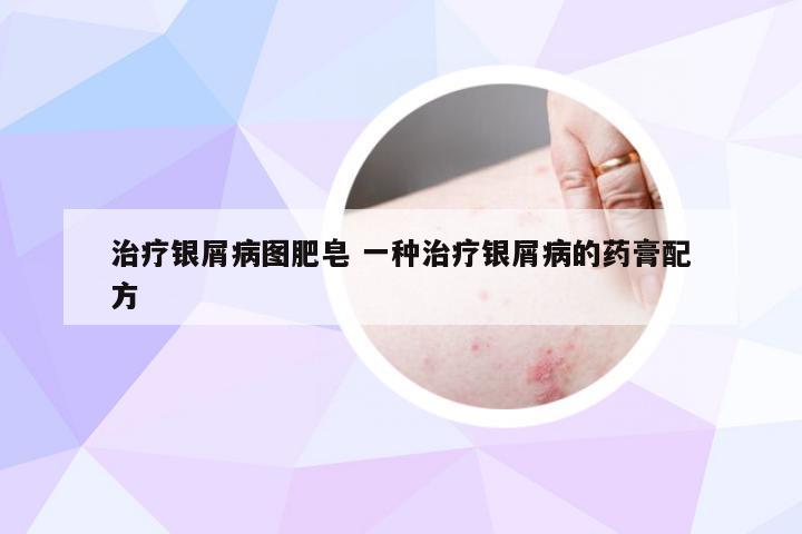 治疗银屑病图肥皂 一种治疗银屑病的药膏配方