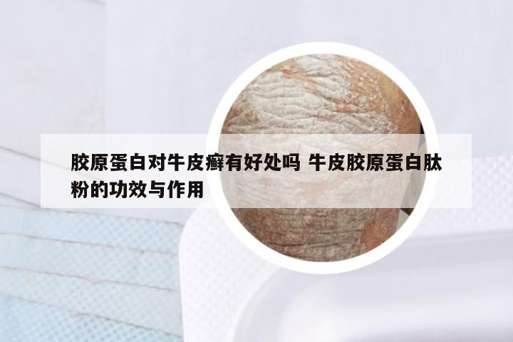 胶原蛋白对牛皮癣有好处吗 牛皮胶原蛋白肽粉的功效与作用