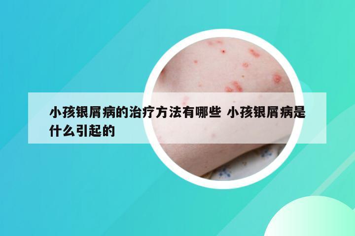小孩银屑病的治疗方法有哪些 小孩银屑病是什么引起的