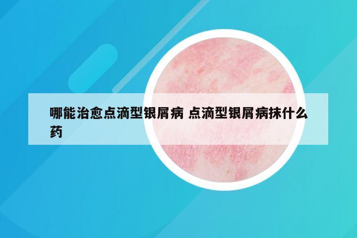 哪能治愈点滴型银屑病 点滴型银屑病抹什么药