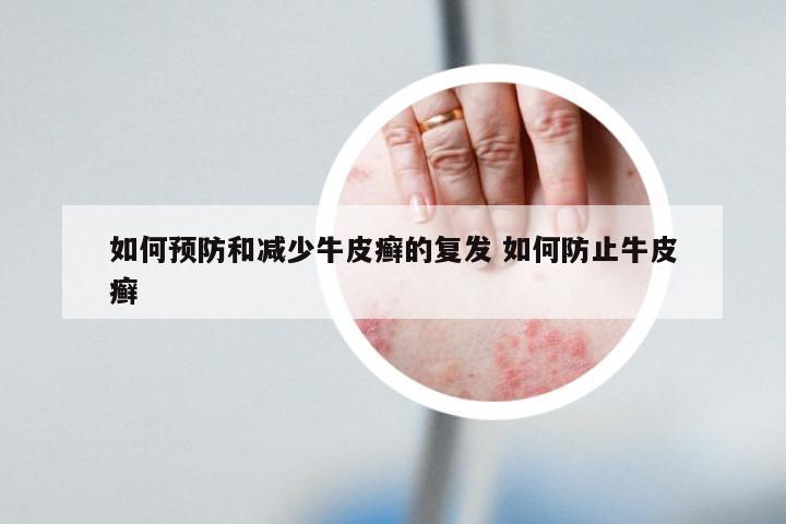 如何预防和减少牛皮癣的复发 如何防止牛皮癣