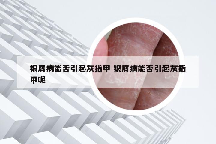 银屑病能否引起灰指甲 银屑病能否引起灰指甲呢
