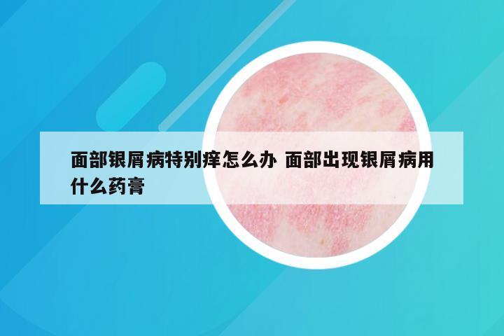 面部银屑病特别痒怎么办 面部出现银屑病用什么药膏