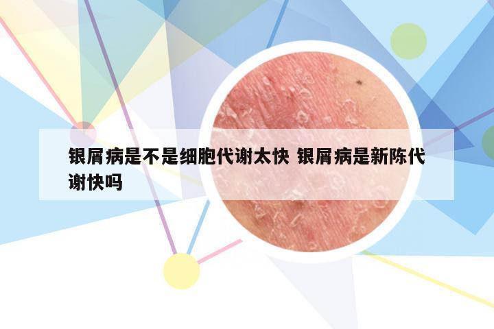 银屑病是不是细胞代谢太快 银屑病是新陈代谢快吗