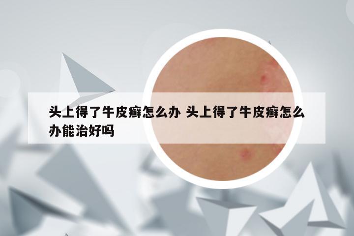 头上得了牛皮癣怎么办 头上得了牛皮癣怎么办能治好吗