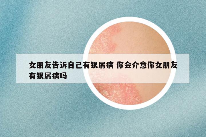 女朋友告诉自己有银屑病 你会介意你女朋友有银屑病吗