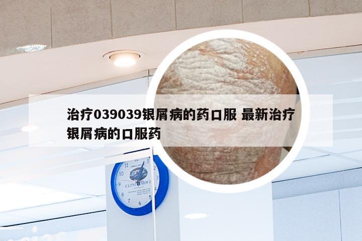 治疗039039银屑病的药口服 最新治疗银屑病的口服药